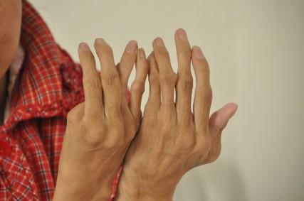 风湿性关节炎症状全解析 早发现早治疗