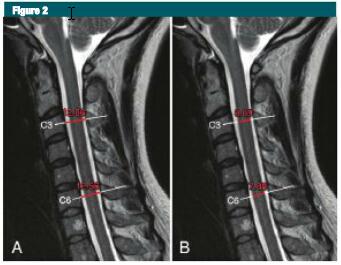 腰椎管狭窄的病理变化过程