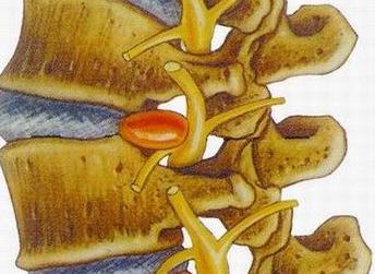 中医对骨质增生的诊断